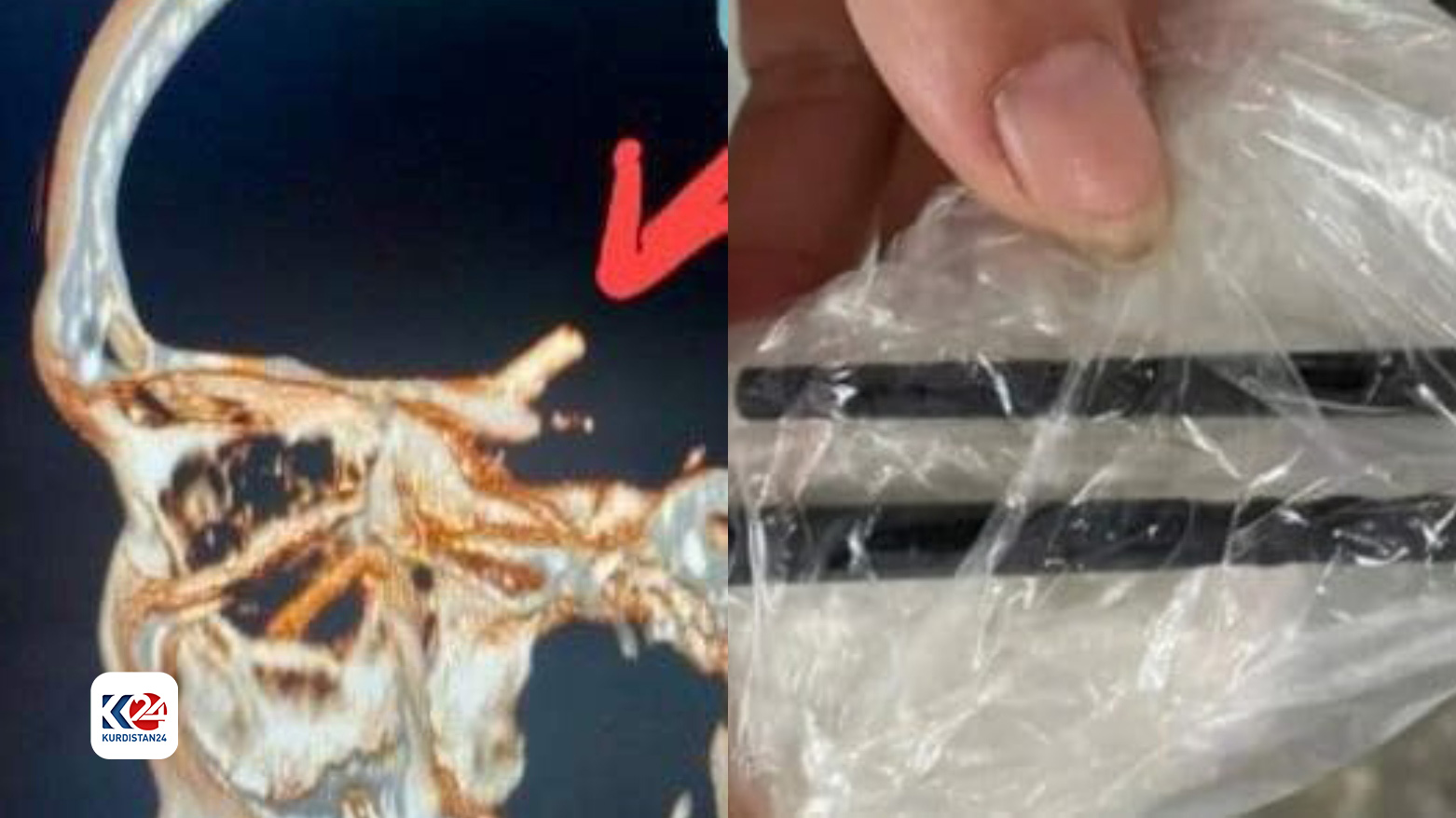 لە حاڵەتێکی نامۆدا دوو چیلکەدار لەناو سەری پیاوێک دۆزرانەوە